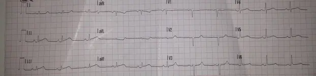 Síncope en cardiópata