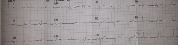 Síncope en cardiópata
