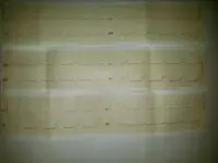 Dolor precordial