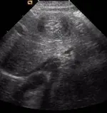 Neonato de 21 dias que consulta en urgencias por vómitos...