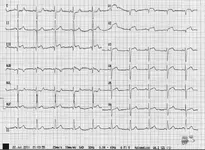 paciente con dolor toracico