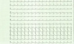 Dolor torácico y no tolerancia al decúbito.