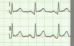 Dolor torácico y no tolerancia al decúbito. Dolor torácico y no tolerancia al decúbito.