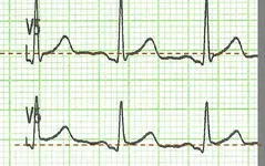 Dolor torácico y no tolerancia al decúbito. Dolor torácico y no tolerancia al decúbito.