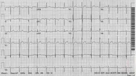 Dextrocardia. La patología congénita de la Sra. Carma Chacón