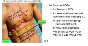 Dextrocardia. La patología congénita de la Sra. Carma Chacón