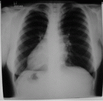 Dextrocardia. La patología congénita de la Sra. Carma Chacón